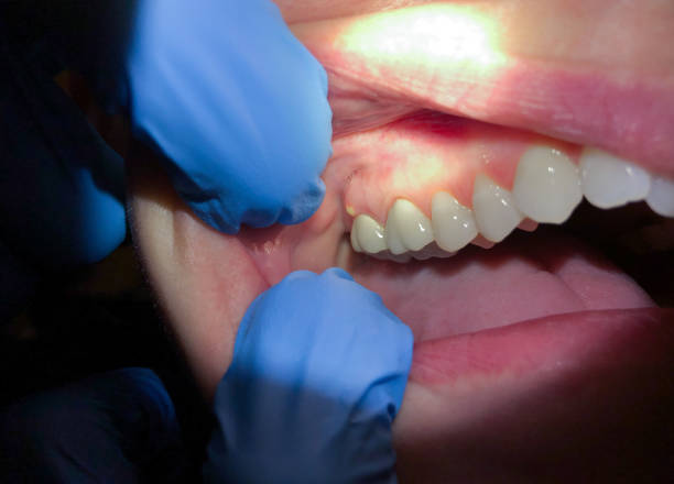 Best Emergency Tooth Extraction in Thomasville, AL